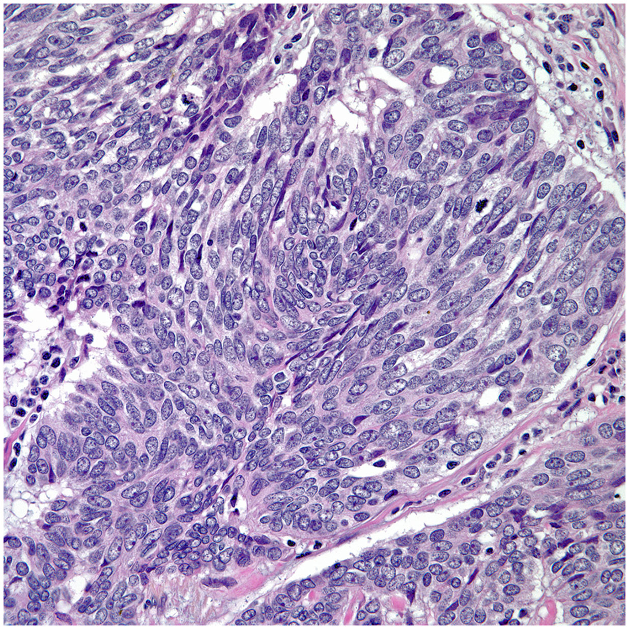 Inflammatory breast cancer